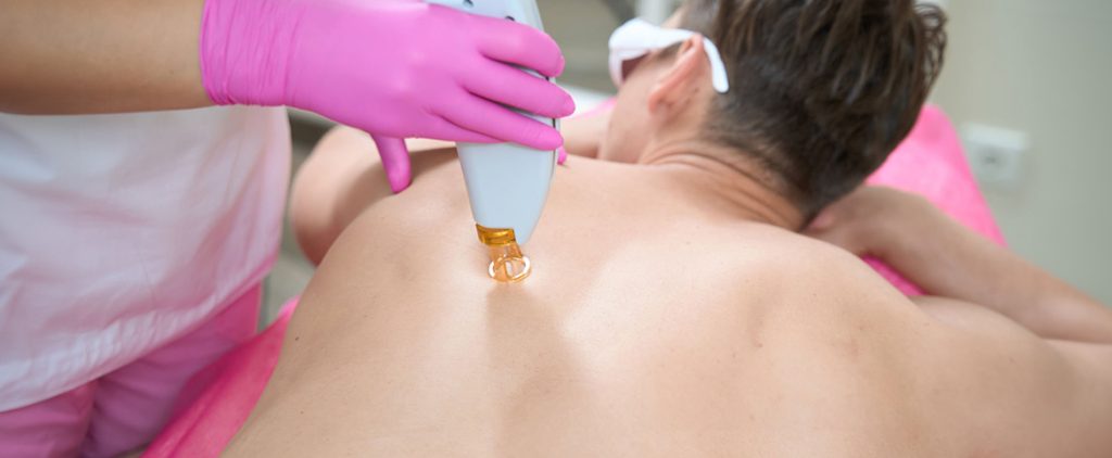 Male Full Body Laser Hair Removal